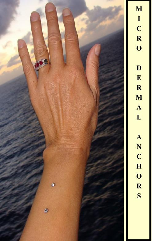 dermal anchor hand